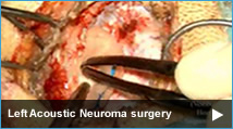 Left Acoustic Neuroma (Vestibular Schwannoma) surgery