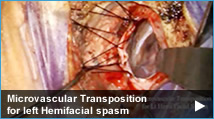 Microvascular Transposition for left Hemifacial spasm